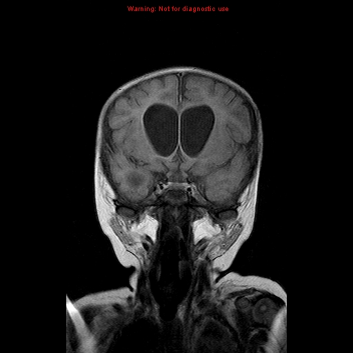 File:Atypical teratoid rhabdoid tumor (Radiopaedia 10712-11183 Coronal FLAIR 13).jpg