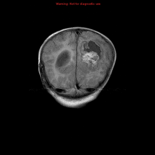 File:Atypical teratoid rhabdoid tumor (Radiopaedia 10712-11183 Coronal FLAIR 4).jpg