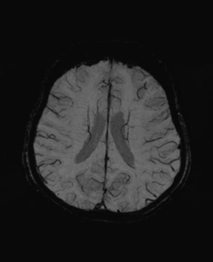 Autoimmune limbic encephalitis (Radiopaedia 30363-31005 SWI - mIP 48).jpg