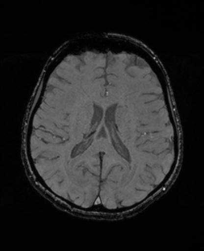 Autoimmune limbic encephalitis (Radiopaedia 30363-31005 SWI - magnitude 47).jpg