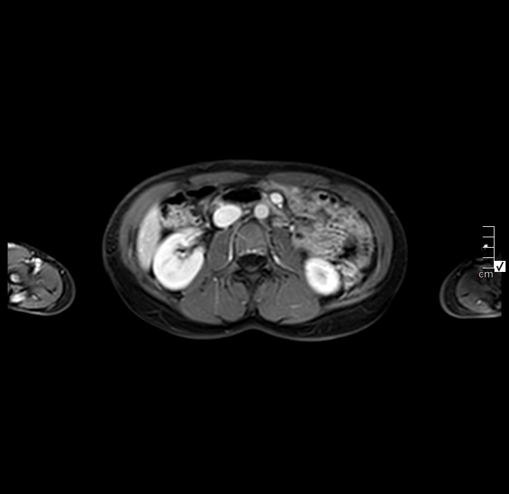 Autoimmune pancreatitis (Radiopaedia 40166-42675 Axial venous phase 16).JPG