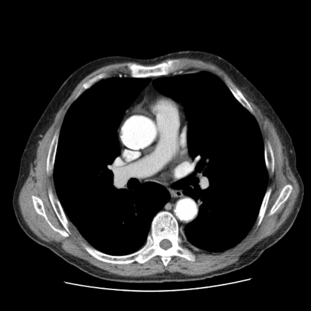 Autosomal dominant polycystic kidney disease (Radiopaedia 27851-28094 B 29).jpg