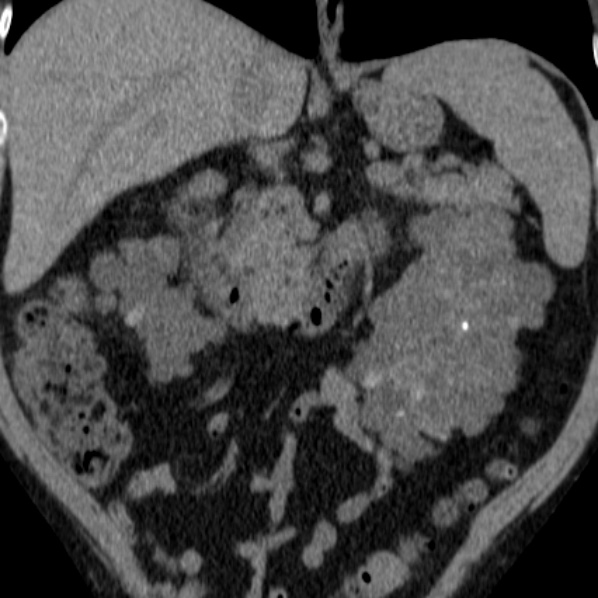 File:Autosomal dominant polycystic kidney disease (Radiopaedia 36539-38101 Coronal non-contrast 16).jpg
