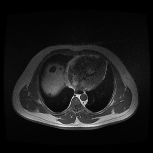 Autosomal dominant polycystic kidney disease (Radiopaedia 50259-55611 Axial 2D Dual Echo 6).jpg