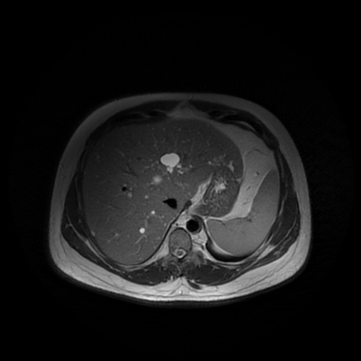 File:Autosomal dominant polycystic kidney disease (Radiopaedia 50259-55611 Axial T2 10).jpg