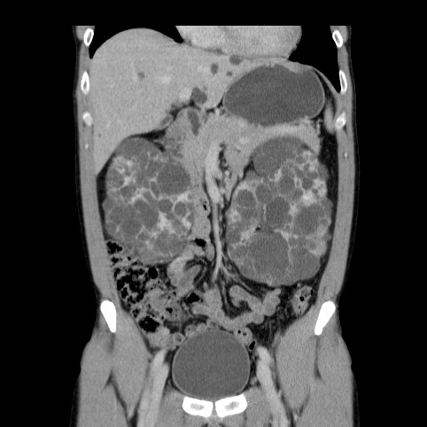 Autosomal dominant polycystic kidney disease (Radiopaedia 66349-75582 A 26).jpg