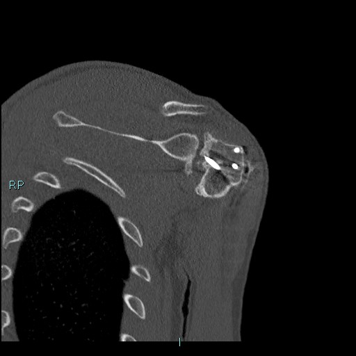 Avascular necrosis after fracture dislocations of the proximal humerus (Radiopaedia 88078-104655 Coronal bone window 92).jpg