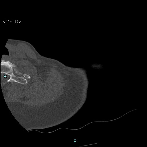 File:Avascular necrosis of the shoulder - Cruess stage I (Radiopaedia 77674-89887 Axial bone window 4).jpg