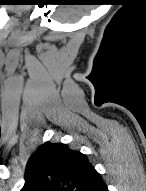 Axis peg fracture (type 3) and atlas lateral mass (type 4) fracture (Radiopaedia 37474-39324 D 5).png