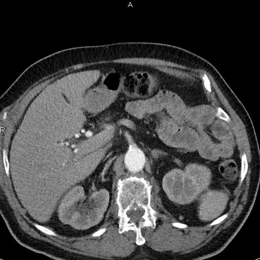 File:Azygos continuation of the inferior vena cava (Radiopaedia 18537-18404 C+ arterial phase 61).jpg