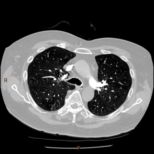 Azygos lobe (Radiopaedia 40161-42821 Axial lung window 24).jpg