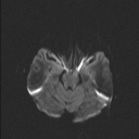Balo concentric sclerosis (Radiopaedia 50458-55940 Axial DWI 61).jpg