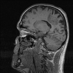 File:Balo concentric sclerosis (Radiopaedia 50458-55940 Sagittal T1 66).jpg