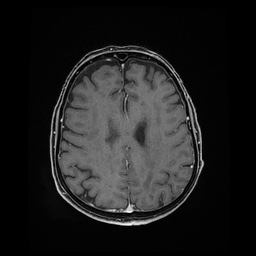 Balo concentric sclerosis (Radiopaedia 53875-59982 Axial LAVA C+ 177).jpg
