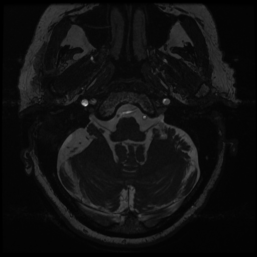 File:Balo concentric sclerosis (Radiopaedia 53875-59982 Axial T2 FIESTA 14).jpg
