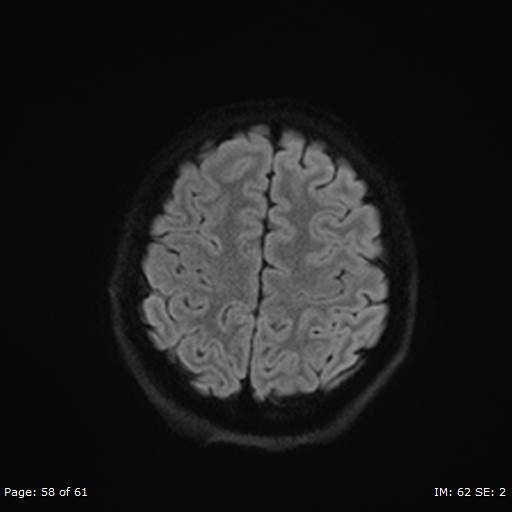 File:Balo concentric sclerosis (Radiopaedia 61637-69636 I 360).jpg