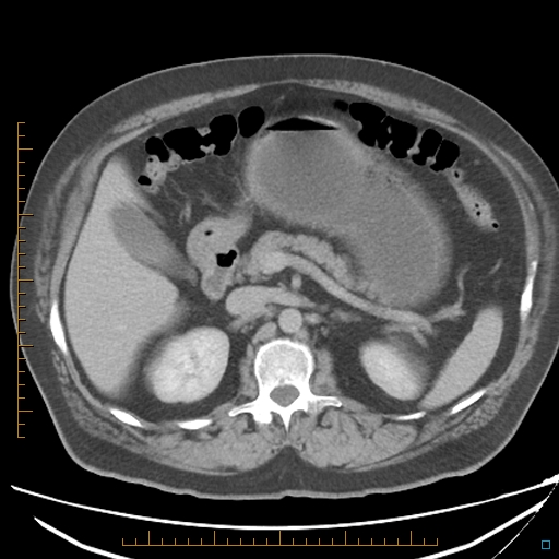 File:Bariatric balloon causing gastric outlet obstruction (Radiopaedia 54449-60672 A 15).jpg