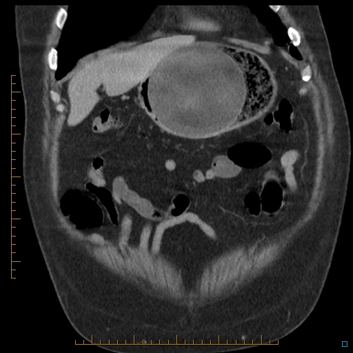 File:Bariatric balloon causing gastric outlet obstruction (Radiopaedia 54449-60672 B 11).jpg
