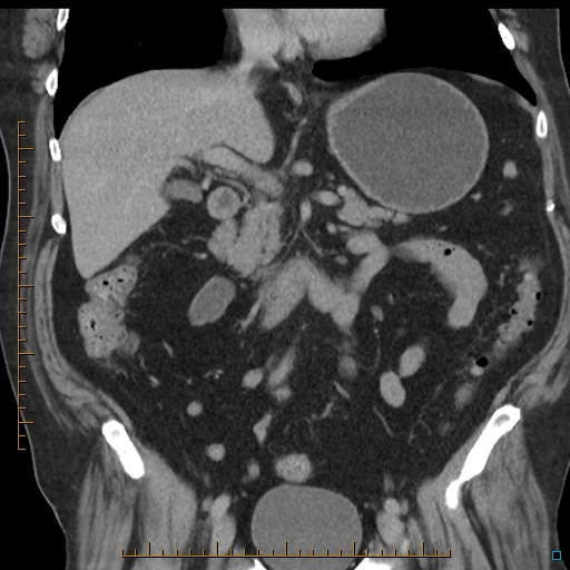 File:Bariatric balloon causing gastric outlet obstruction (Radiopaedia 54449-60672 B 28).jpg