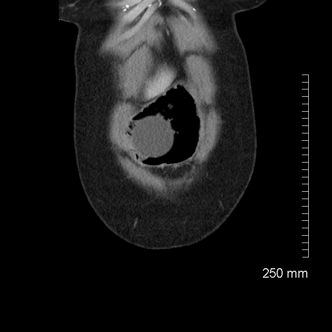Bariatric intragastric ballon (Radiopaedia 62114-70216 B 8).jpg