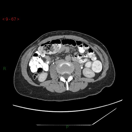 File:Bartholin gland cyst (Radiopaedia 54904-61181 Axial C+ delayed 17).jpg