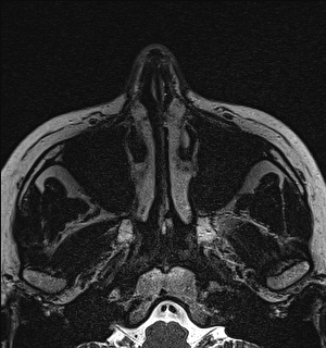 Basal cell carcinoma - nasal region (Radiopaedia 70292-80365 Axial Gradient Echo 13).jpg