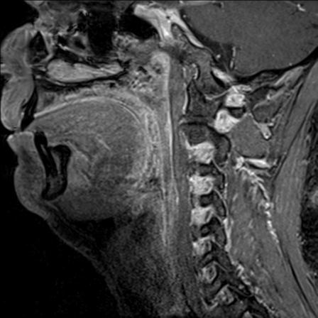 File:Base of tongue squamous cell carcinoma (Radiopaedia 31174-31884 F 106).jpg
