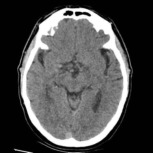 File:Basilar artery occlusion (Radiopaedia 33570-34659 Axial non-contrast 17).png