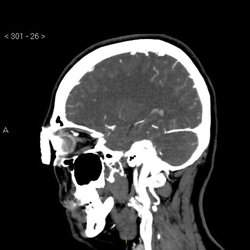 File:Basilar artery thrombosis (Radiopaedia 16260-15944 C 20).jpg