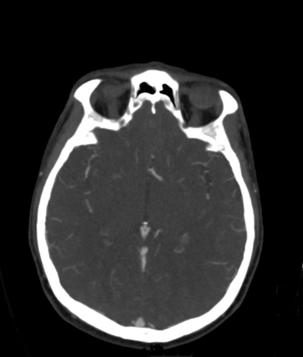 Basilar artery thrombosis and ascending transtentorial herniation (Radiopaedia 84759-100360 B 28).jpg