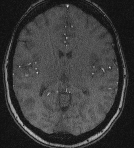 File:Basilar tip aneurysm (Radiopaedia 26504-26632 MRA 136).jpg