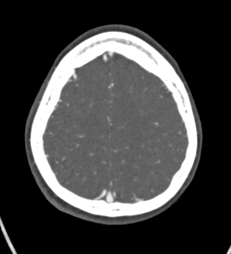 Basilar tip aneurysm with coiling (Radiopaedia 53912-60086 A 121).jpg