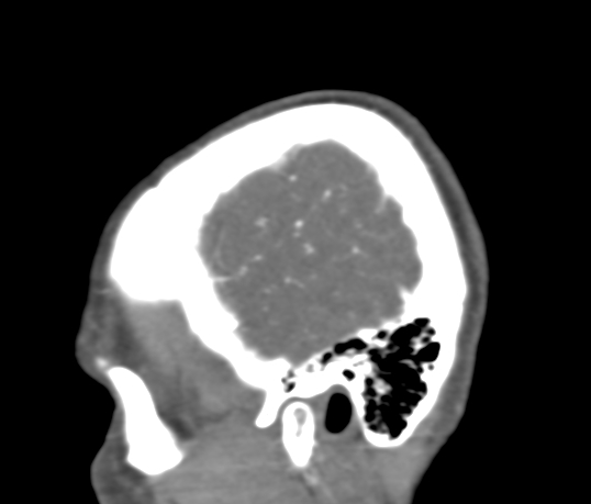 File:Basilar tip aneurysm with coiling (Radiopaedia 53912-60086 C 9).jpg