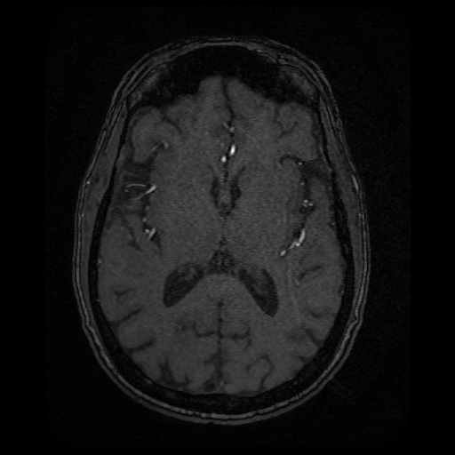 Basilar top and left middle cerebral artery aneurysm (Radiopaedia 61965-70031 Axial MRA 89).jpg