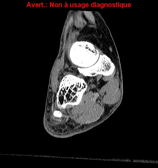 Baxter neuropathy (Radiopaedia 25988-26125 Coronal non-contrast 3).jpg