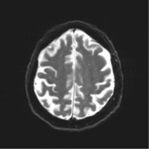 Behavioral variant frontotemporal dementia and late onset schizophrenia (Radiopaedia 52197-58083 Axial DTI Trace W 20).png