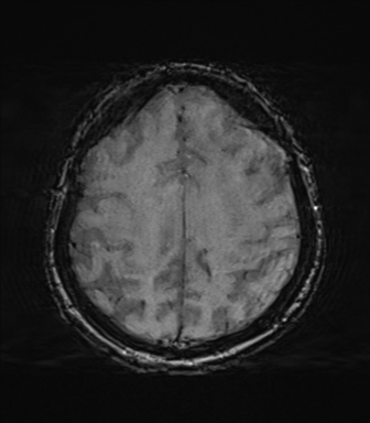 File:Behavioral variant frontotemporal dementia and late onset schizophrenia (Radiopaedia 52197-58083 Axial SWI 57).png