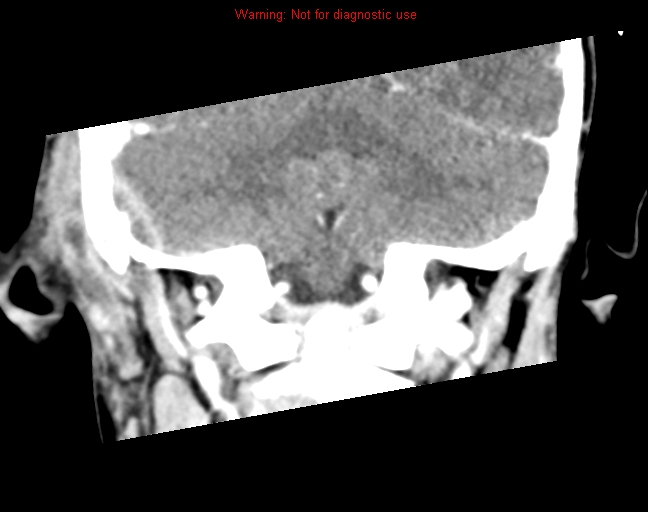 File:Bezold abscess (Radiopaedia 21645-21605 C+ arterial phase 18).jpg