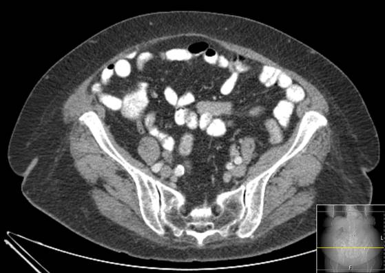 Bicameral celiacomesenteric aneurysm (Radiopaedia 55766-62327 A 51).jpg