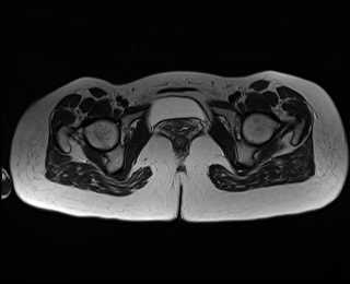 File:Bicornuate bicollis uterus (Radiopaedia 61626-69616 Axial T2 33).jpg