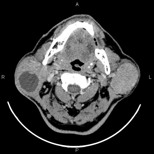 Bilateral Warthin tumors (Radiopaedia 84034-99263 Axial With contrast 25).jpg