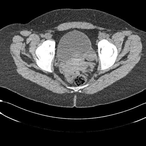 File:Bilateral acetabular protrusion with pincer type femoro-acetabular impingement (Radiopaedia 30134-30733 AXIAL SOFT THIN 35).jpg