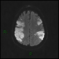 File:Bilateral acute middle cerebral artery territory infarcts (Radiopaedia 77319-89402 Axial DWI 42).jpg