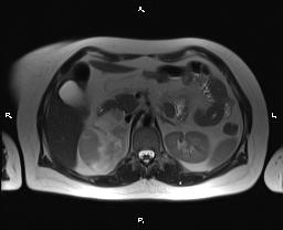 File:Bilateral adrenal myelolipoma (Radiopaedia 63058-71537 Axial T2 15).jpg