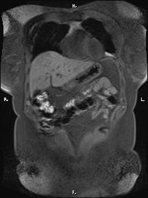 Bilateral adrenal myelolipoma (Radiopaedia 63058-71537 Coronal T1 fat sat 83).jpg