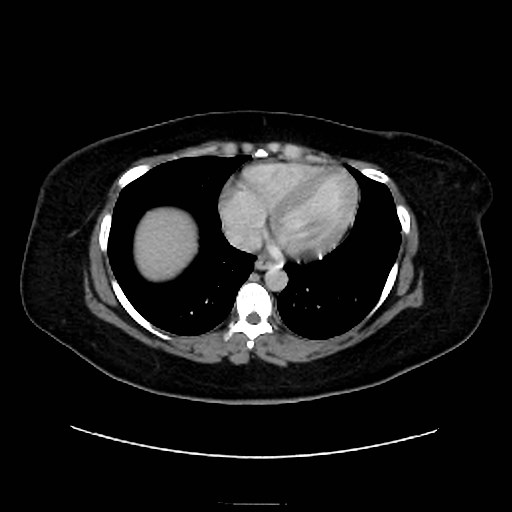 Bilateral adrenal thrombosis (Radiopaedia 58182-65256 A 1).jpg