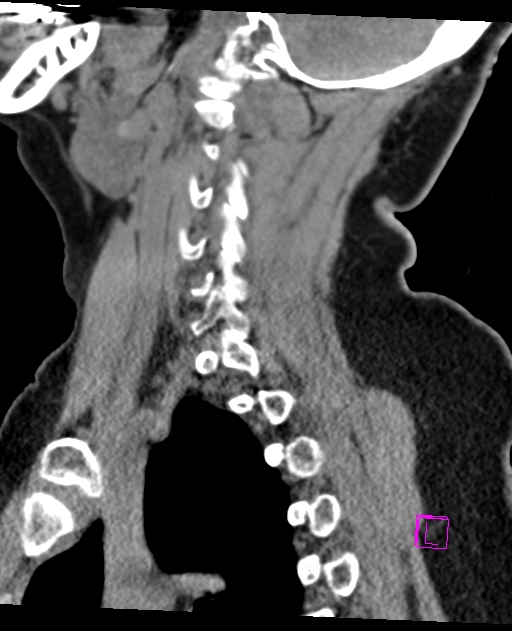 Bilateral atlanto-occipital assimilation (Radiopaedia 28350-28603 D 56).jpg