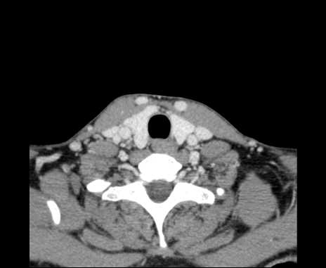 Bilateral carotid body tumors (Radiopaedia 61841-69870 Axial Post contrast 93).jpg