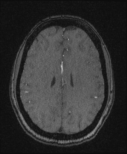 Bilateral carotid body tumors and right glomus jugulare tumor (Radiopaedia 20024-20060 Axial MRA 123).jpg