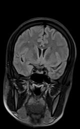 File:Bilateral carotid body tumors and right jugular paraganglioma (Radiopaedia 20024-20060 Coronal 61).jpg